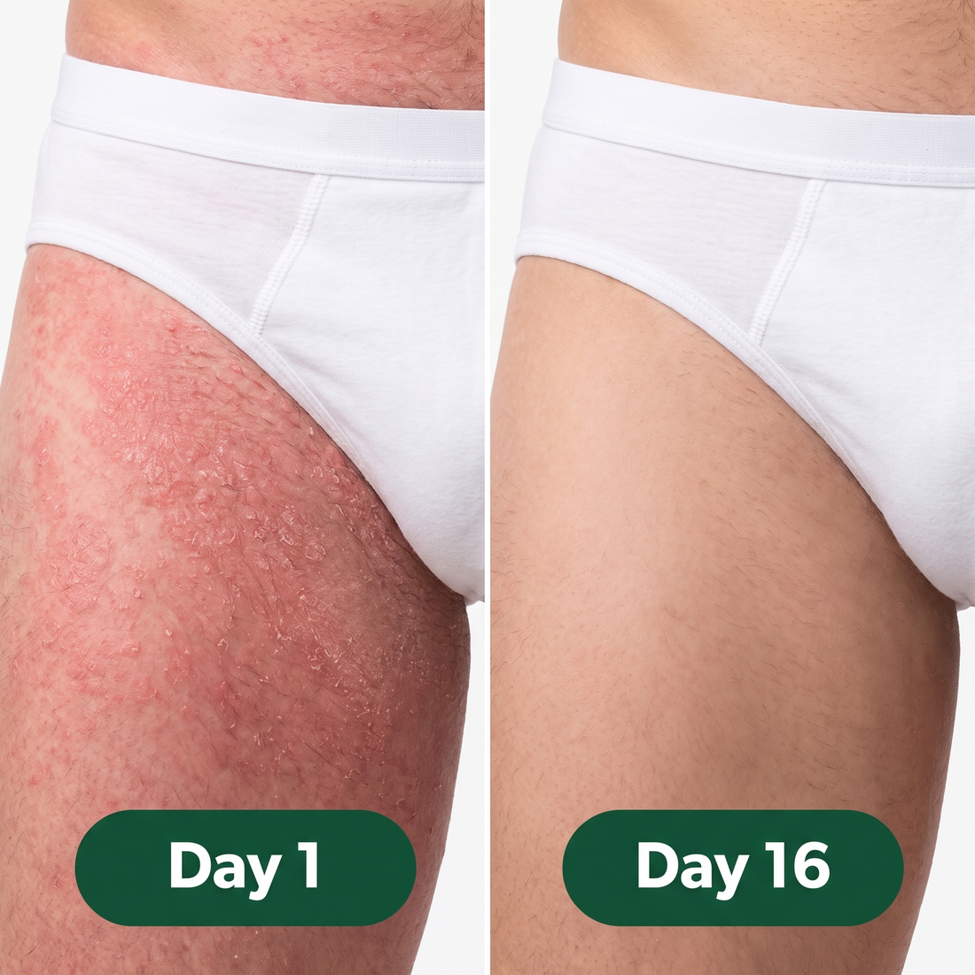 Jock itch groin before and after - day 1 to day 16