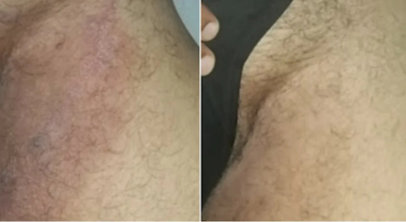 "Four years of jock itch — gone in days"